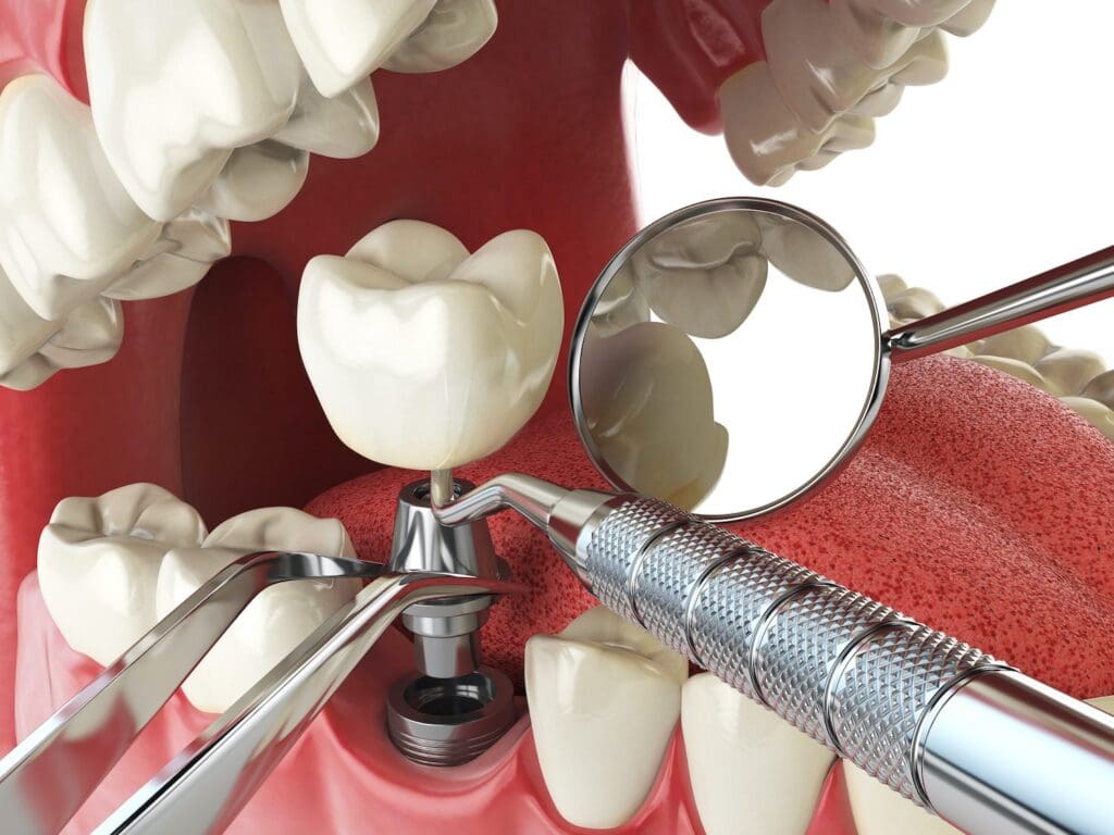 This article explores the various benefits dental implants can provide and why you should consider them if you are missing a tooth.