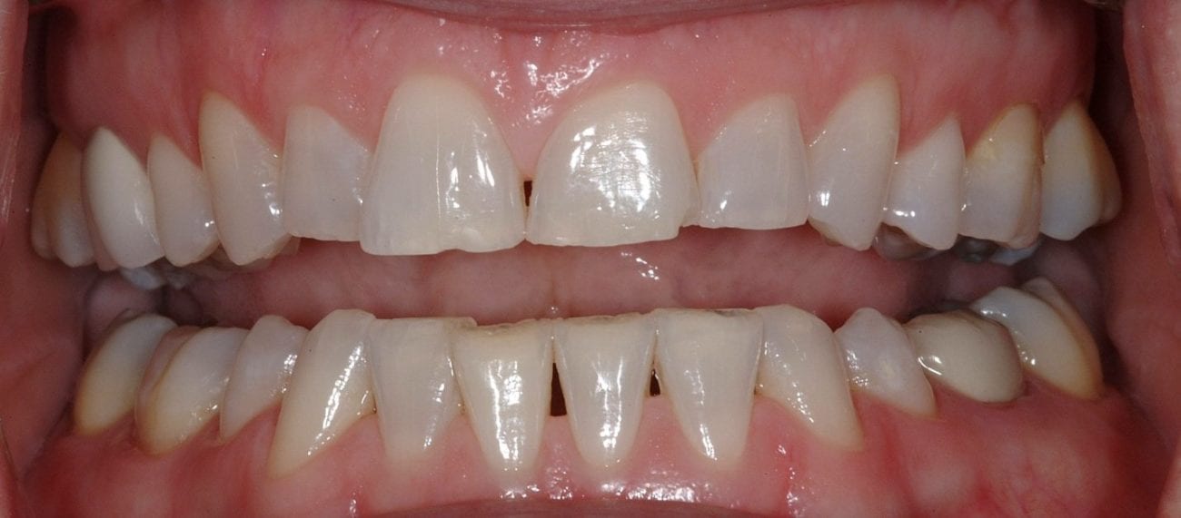 Case-5-Before-Maxillary-Anterior-Teeth-Severe-Wear