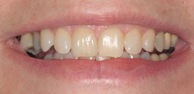 case-10-after-Orthodontic-Correction-Single-Tooth-Implant