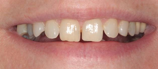 case-10-before-Orthodontic-Correction-Single-Tooth-Implant