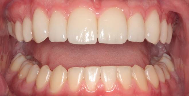 case-12-after-Microdontia (1)