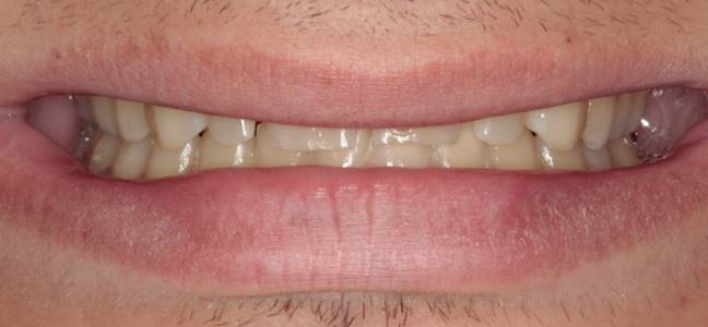 case-12-before-Microdontia (1)