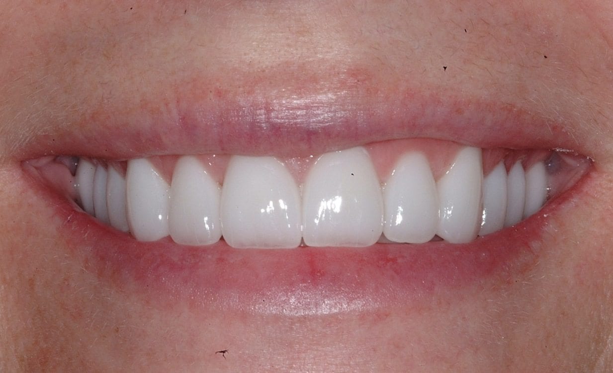 case-7-after-Severe-Acid-Erosion-of-Maxillary-Teeth