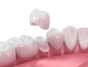 Although it may feel like an emergency, most dental crown issues can be managed calmly with the right steps.